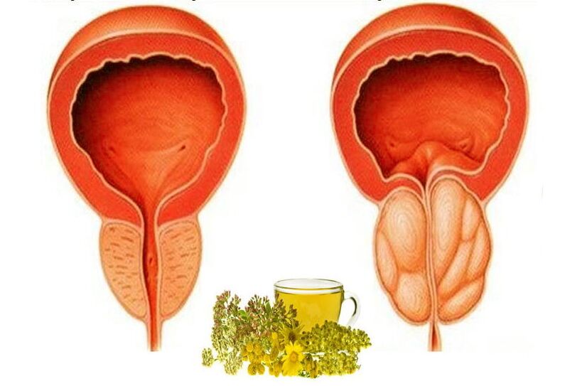 Healthy and inflamed prostate