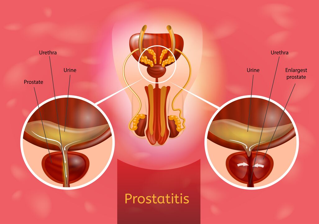 Prostatitis